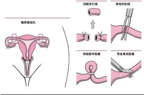 一开始,医生会找准女性结扎的准确位置,然后把肚皮划开,在肚脐下5厘米