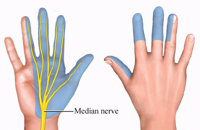 正因为里面有一根叫做正中神经的主要神经通过,所以如果出现腕管综合