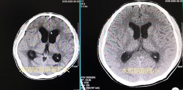 脑积水的症状有哪些?(脑部有积水有什么症状表现)