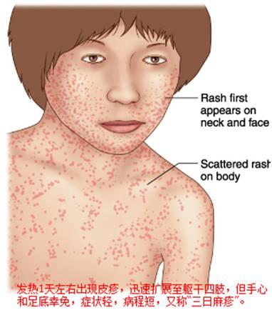 风疹块图片原因图片