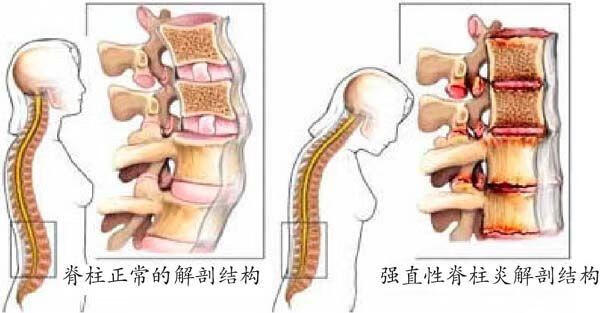 强直性脊柱炎症状表现(女性强直性脊柱炎症状)